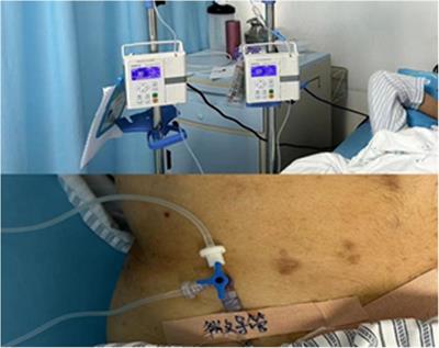 Effect of lidocaine pumped through hepatic artery to relieve pain of hepatic artery infusion chemotherapy